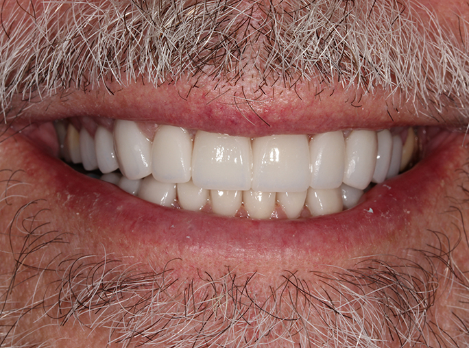 Rocklin Dentist Patient After
