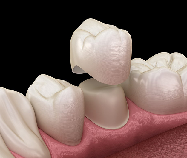 Dental Crowns In Rocklin CA