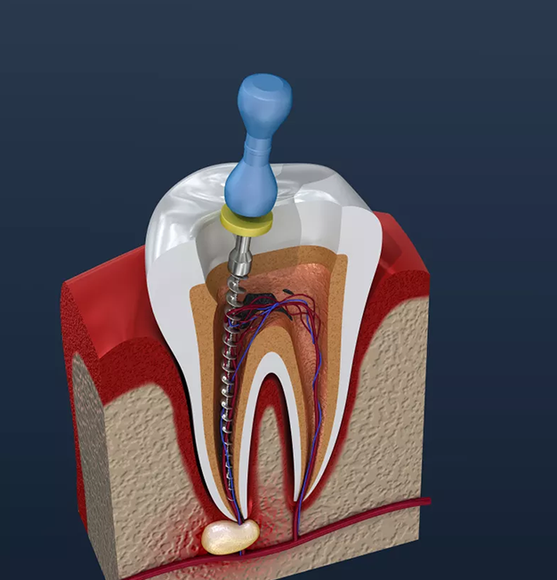 Root Canal Treatment In Rocklin CA