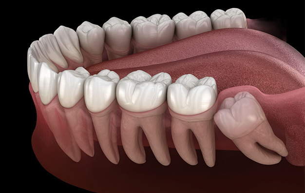 Wisdom Tooth Removal In Rocklin CA