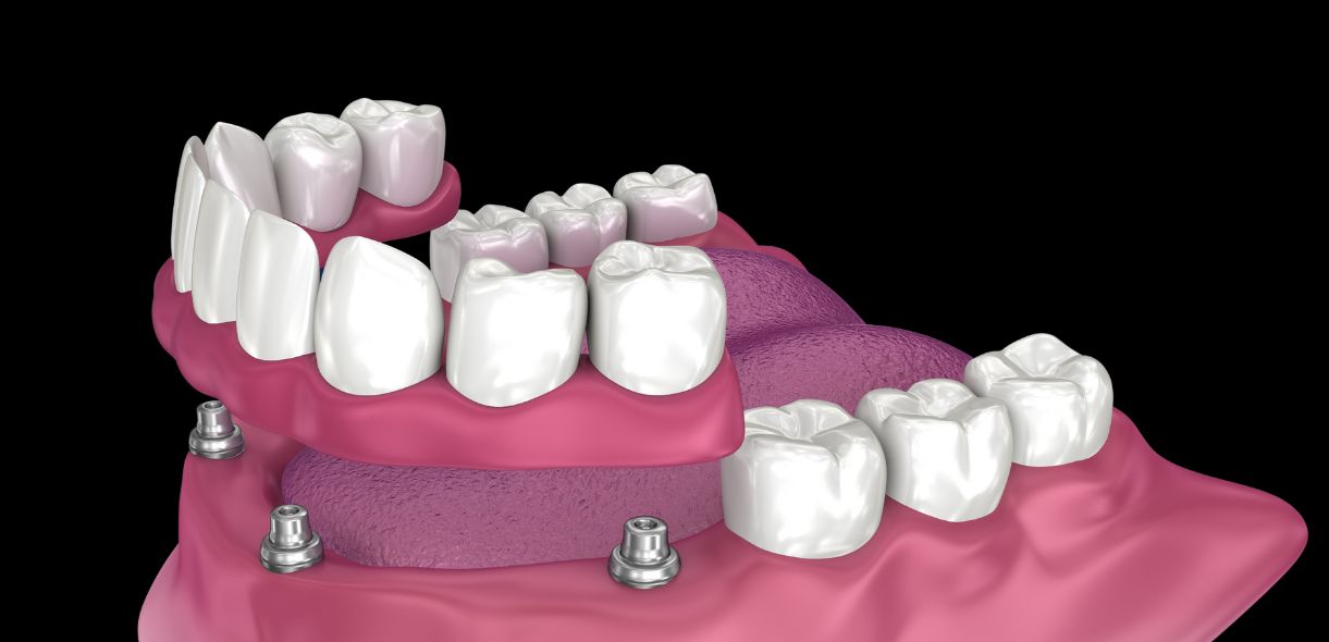 All In 4 And All In 6 Implants - Discover Dental Rocklin
