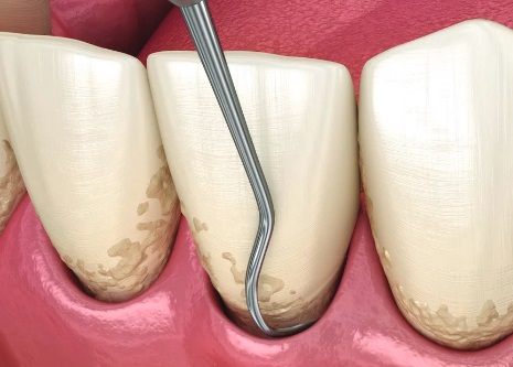 Periodontal Scaling and Root Planing Post-Op
