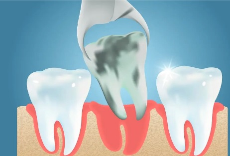 Tooth Extraction Post-Op Instructions