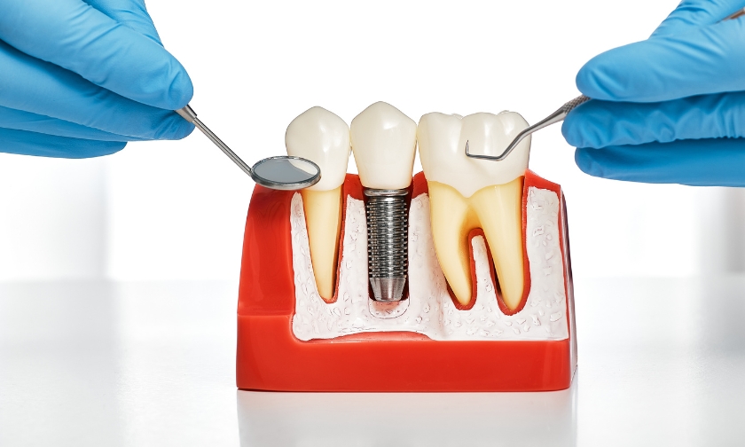 pre-surgical checklist for dental implants