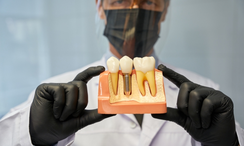 tips for caring for dental implants