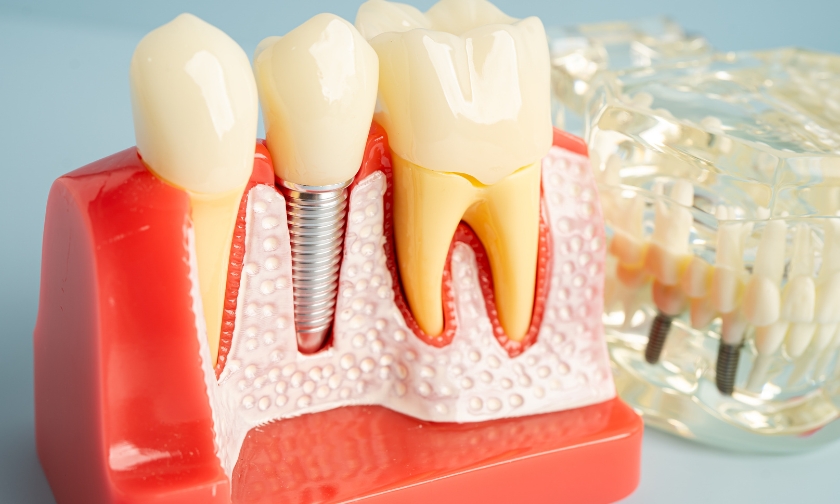 Is it True that Dental Implants Never Get Cavities?