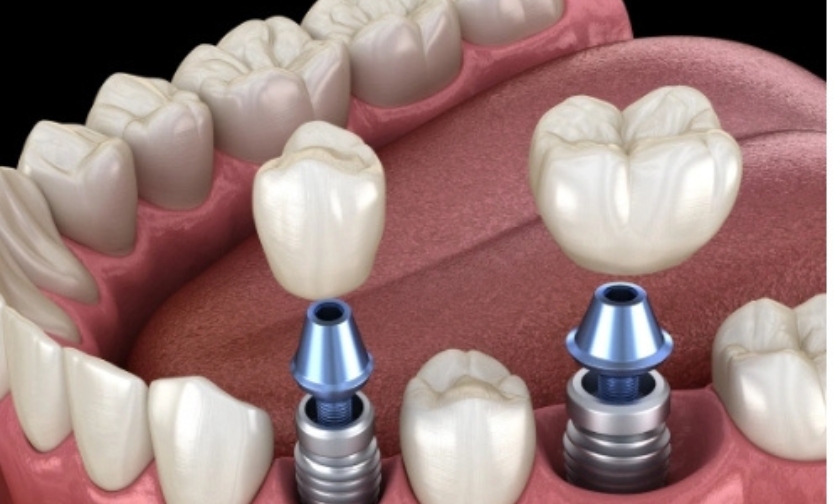 Best Post-op Nutrition Tips for Dental Implant Patients